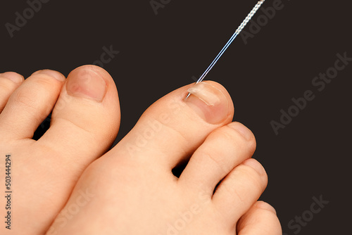 Big toe nail injury. Doctor-podolog removes dead nails. A runner with a professional injury. Cracked toenail. Isolated leg with a broken nail. A podiatrist works with a diseased nail. 