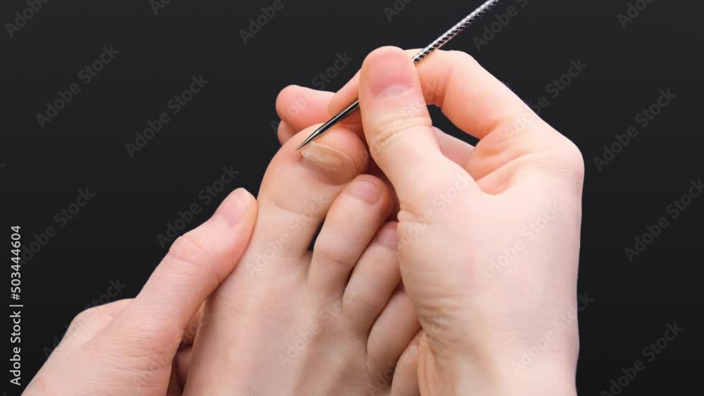 Big toe nail injury. Doctor-podolog removes dead nails. A runner with a professional injury. Cracked toenail. Isolated leg with a broken nail. A podiatrist works with a diseased nail. Big toe nail injury. Doctor-podolog removes dead nails. A runner with a professional injury. Cracked toenail. Isolated leg with a broken nail. A podiatrist works with a diseased nail.