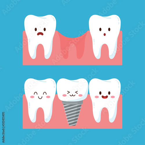 Dental implant before and after, cute teeth character and gum, flat vector illustration isolated on white background.