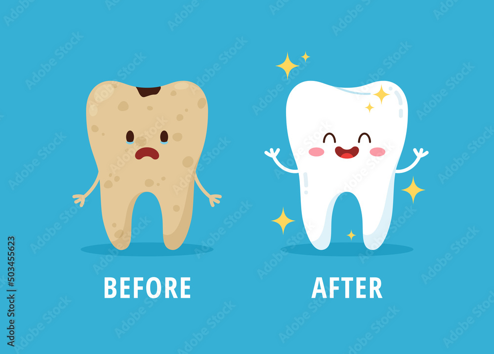 Before and after dental cleaning or whitening and treatment, flat vector illustration on blue background. - obrazy, fototapety, plakaty 