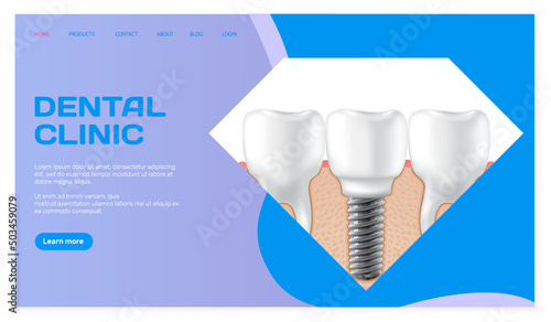 Dental clinic poster vector illustration. Advertising of hospital for teeth treatment. Medical services for installation of dental implant. Human gum with healthy teeth and denture on dentistry banner