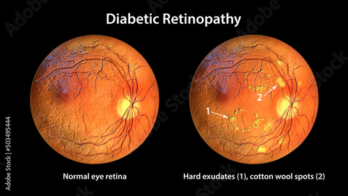 Non-proliferative diabetic retinopathy, 3D illustration photo