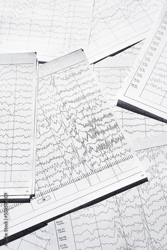 Electroencephalogram diagnostic rezults after epilepsy. Brain wave patterns on EEG.