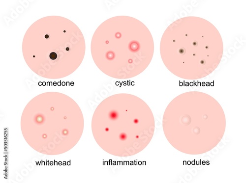 Pimples on the skin. Types of acne, acne comedones, cystic, inflammation, whiteheads on the face.Vector illustration.
