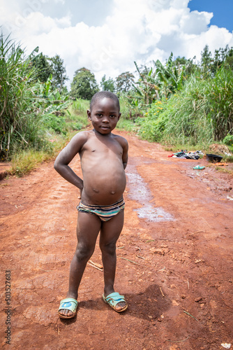 African child suffering from Kwashiorkor. His belly is swollen from malnutrition photo