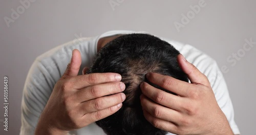 man examining his bald patches on scalp, male pattern hair loss photo