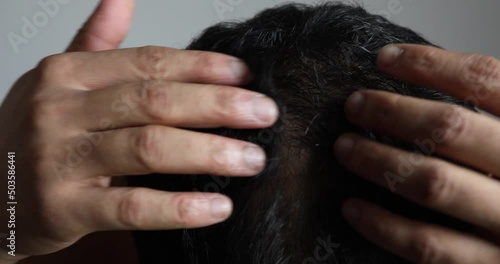 Male baldness, hair loss, dandruff on head, visible scalp. Man touching his thinning hair or alopecia head. photo