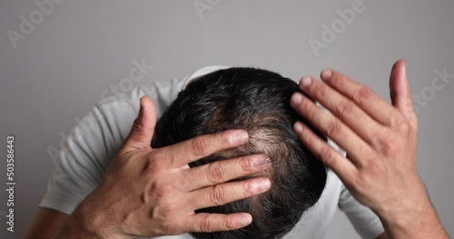 man showing visible hair loss scalp and examining bald patch photo