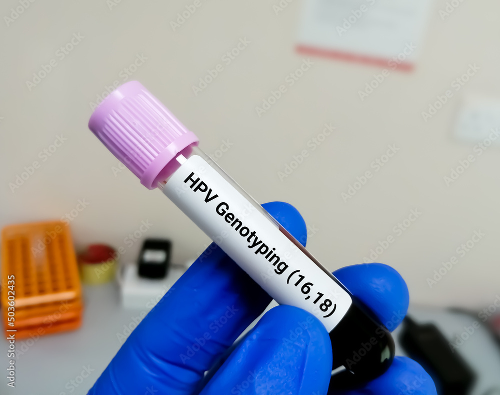 Blood sample for Human papillomavirus (HPV) genotyping testing in PCR