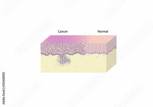 morphology of cervical cancer under a microscope, illustration, vector, eps