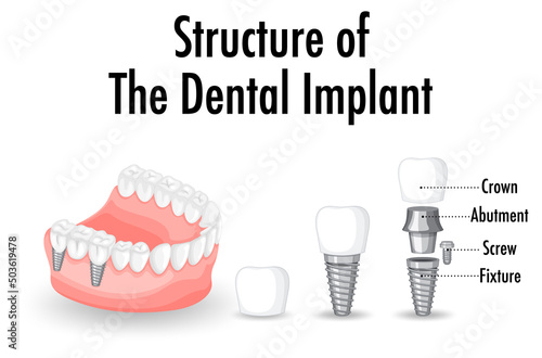 Structure of the dental implant on white background