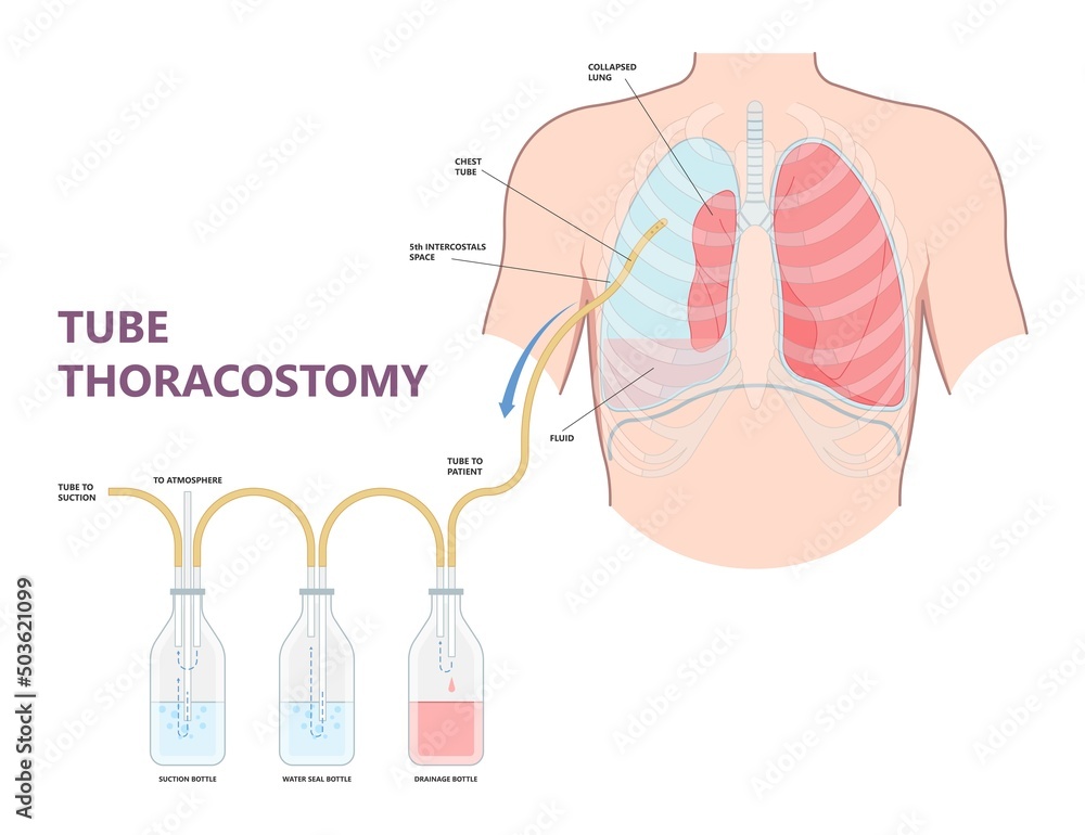 Lung cancer collapse chest pain drain rib bleb blunt insert tube fluid