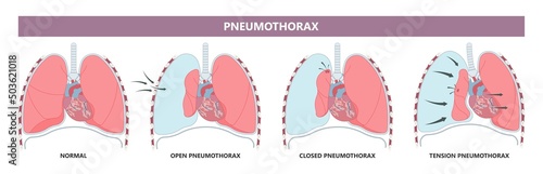 Lung cancer collapse chest pain drain rib bleb blunt insert tube fluid care disease cystic surgery oxygen blood triangle of safety suction pleurisy bleeding pus failure edema placement Disease Therapy