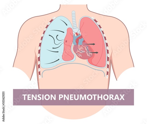 Lung cancer collapse chest pain drain rib bleb blunt insert tube fluid care disease cystic surgery oxygen blood triangle of safety suction pleurisy bleeding pus failure edema placement Disease Therapy