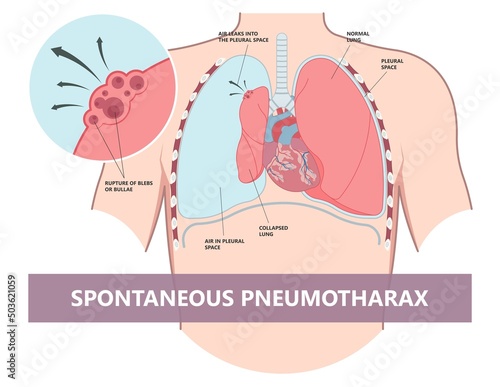 Lung cancer collapse chest pain drain rib bleb blunt insert tube fluid care disease cystic surgery oxygen blood triangle of safety suction pleurisy bleeding pus failure edema placement Disease Therapy