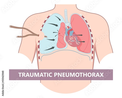 Lung cancer collapse chest pain drain rib bleb blunt insert tube fluid care disease cystic surgery oxygen blood triangle of safety suction pleurisy bleeding pus failure edema placement Disease Therapy