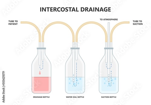 Lung cancer collapse chest pain drain rib bleb blunt insert tube fluid care disease cystic surgery oxygen blood triangle of safety suction pleurisy bleeding pus failure edema placement Disease Therapy
