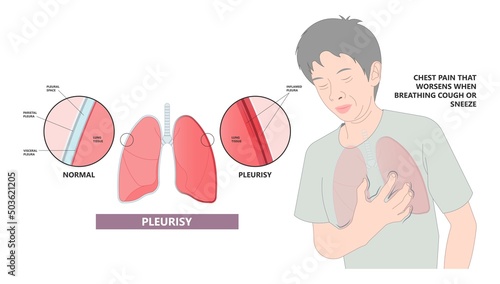 Pleurisy Lung covid 19 virus lupus pain chest xray fluid pleura shortness of breath flu cough sneeze cancer COPD