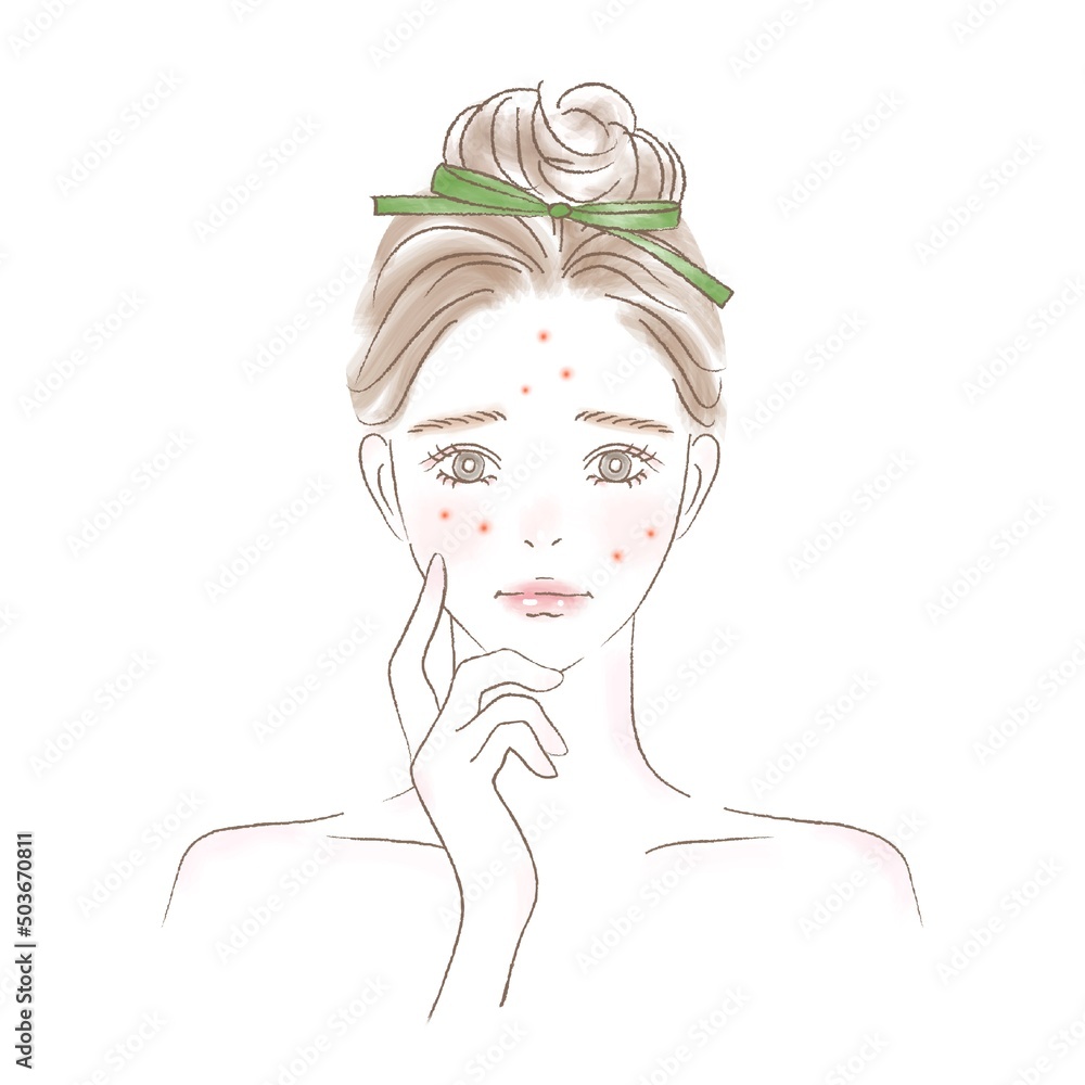 ニキビに悩む女性のイラスト ニキビに悩む女性のイラスト