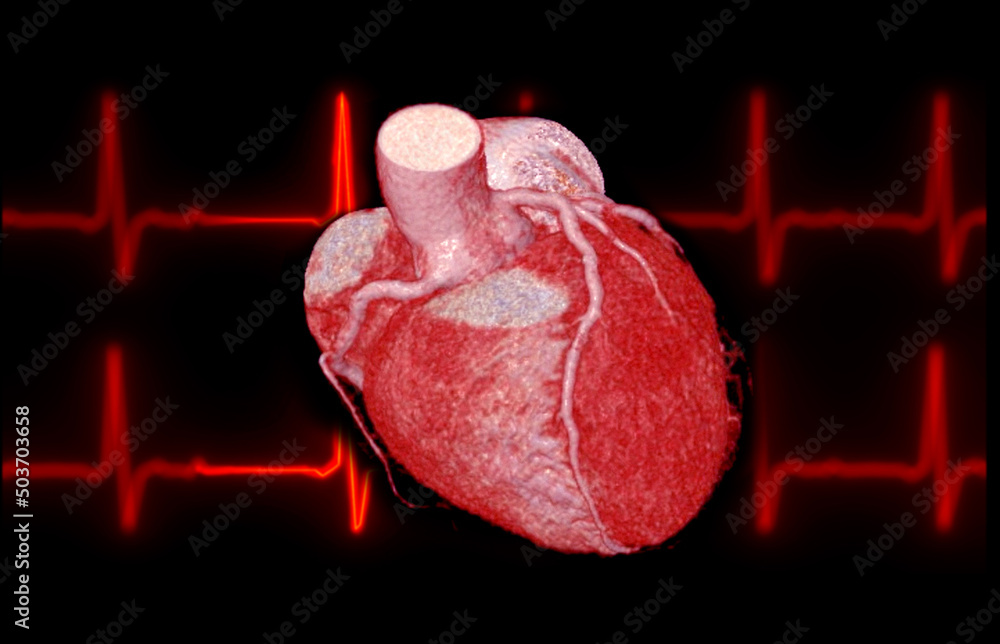 CTA Coronary artery 3D rendering image on the screen for diagnosis of ...