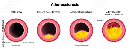 Stage of atherosclerosis vector. Coronary artery syndrome. Coronary heart disease. Causes of myocardial ischemia. photo