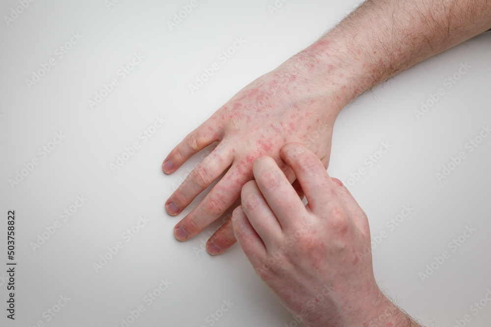Fingers scratching hands with allergic red rash. Derma disease with painful itchy sores. Two hands of patient on white table, top view Fingers scratching hands with allergic red rash. Derma disease with painful itchy sores. Two hands of patient on white table, top view