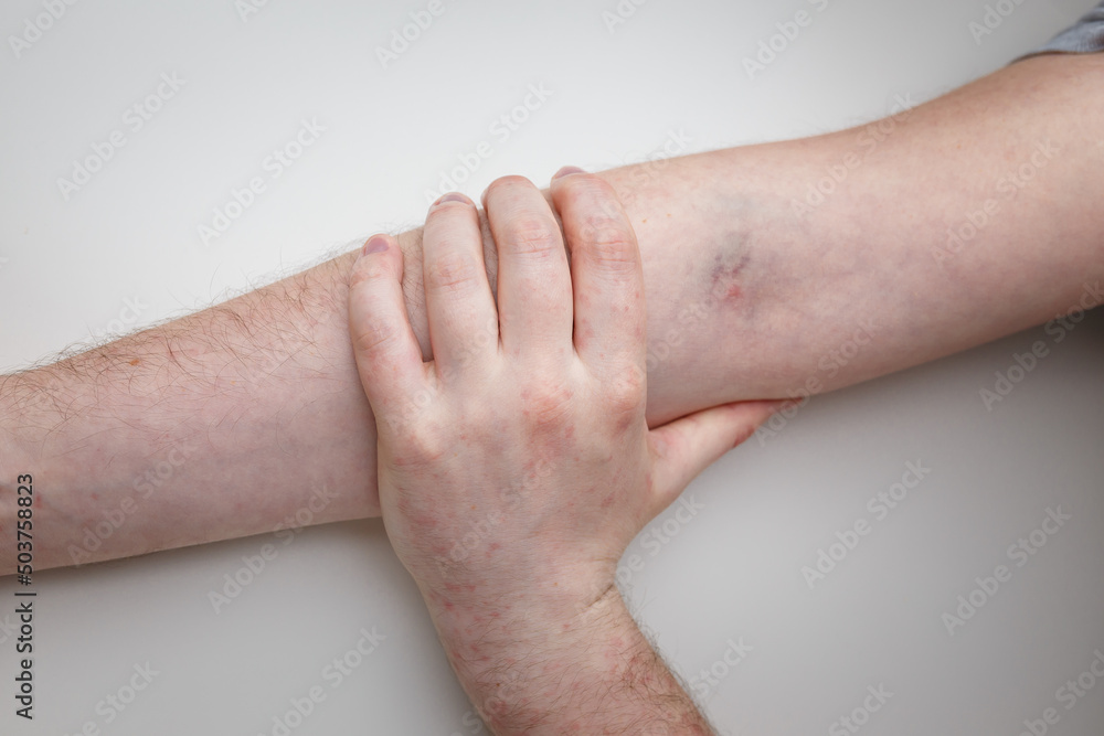 Fototapeta premium Male arm with syringe injection mark from vaccine. Reddening reaction and rash by effect of vaccinated patient. Hands top view