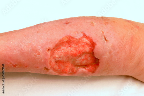 Deep trophic ulcer on leg, defect of skin and soft tissues. Complications of varicose veins of lower leg, weeping trophic wound, eczema, dermatitis. severe medical illness photo