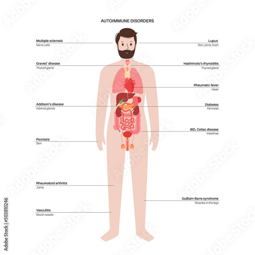 Autoimmune disorders diseases