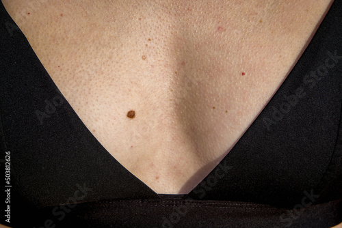 Close-up of a Mole on the Skin of the Neckline Area. Dermatological Concept of Freckle on the Breast of a Woman with Black Bikini photo