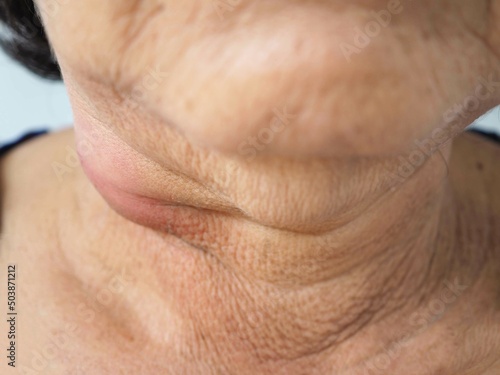 Fototapeta Woman neck lymph node inflammation. closeup photo, blurred.