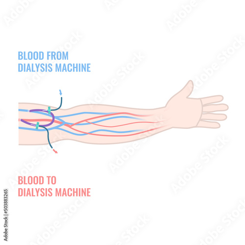 Arteriovenous dialysis shunt graft catheter for hemodialysis sessions. Arm with surgically inserted tube connecting artery to vein under skin. Medical vector illustration.
