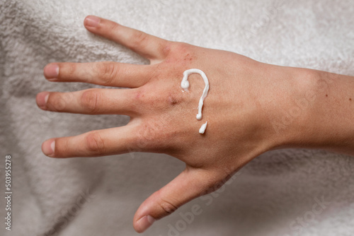 Dry hands with wounds. A question mark is painted on the hands with cream.