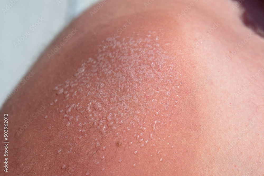 fresh little sunburn bubbles on a man's shoulder. use uv protection fresh little sunburn bubbles on a man's shoulder. use uv protection