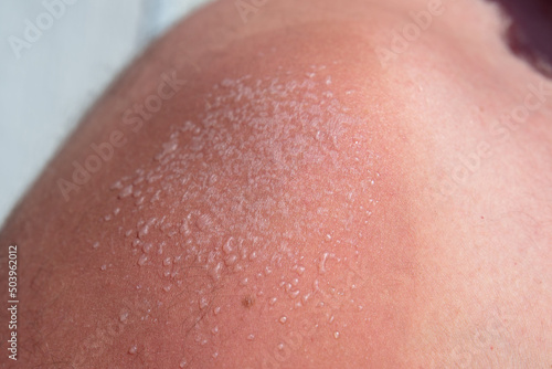 fresh little sunburn bubbles on a man's shoulder. use uv protection