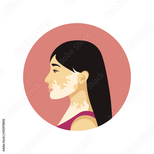 Vector portrait of a young asian woman with vitiligo