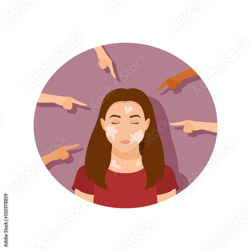 Portrait of a sad girl with vitiligo surrounded by pointing hands. Bullying and discrimination