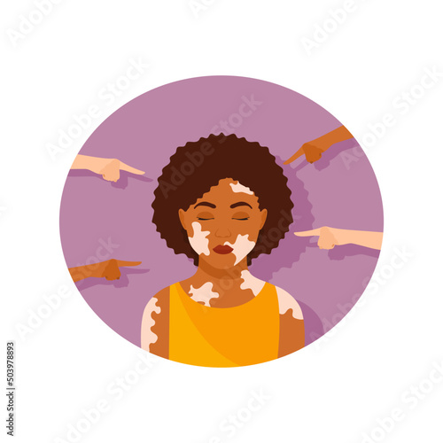 Portrait of an upset dark-skinned woman with vitiligo surrounded by pointing hands. Bullying and discrimination