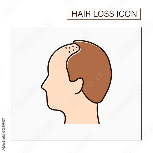 Hair loss color icon. Man loses hair. Male pattern baldness. Alopecia concept. Isolated vector illustration
