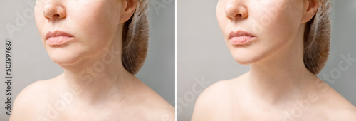 Female double chin before and after correction. Correction of the chin shape liposuction of the neck. The result of the procedure in the clinic of aesthetic medicine.