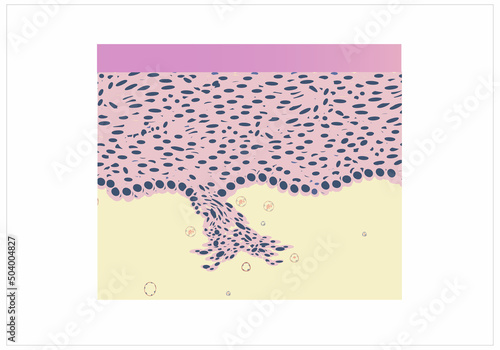 morphology of cervical cancer under a microscope, illustration, vector