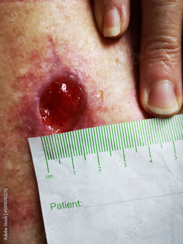Wound Dehiscence measuring 2 cms - occurs when medical stitches, staples, or surgical glue have split apart, or if you see any holes forming in the wound. Packing of the wound is required until healed photo