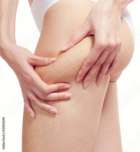 Young woman in underwear squeezing skin to show cellulite and stretch marks isolated on white background
