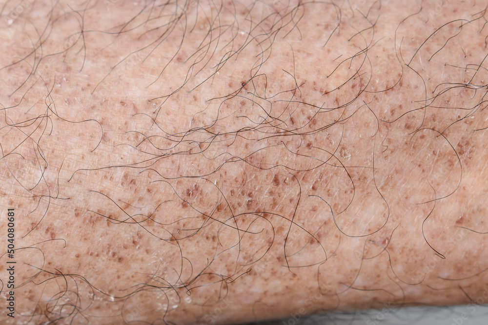 Age spots on the leg. They are brown, gray, or black spots and also called liver spots, senile lentigo, solar lentigines, or sun spots. Age spots on the leg. They are brown, gray, or black spots and also called liver spots, senile lentigo, solar lentigines, or sun spots.