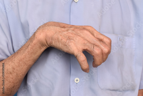 Fotografía Volkmann’s contracture in Southeast Asian elder man.