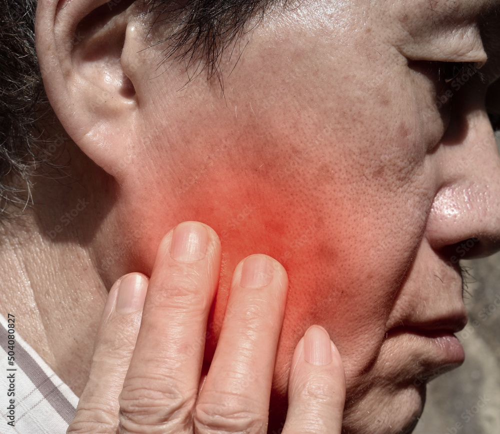 Fototapeta premium Inflammation at the cheek of Asian patient. He feels toothache.