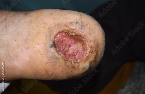 Cuadro en lienzo Diabetes foot ulcer in foot of Asian patient.