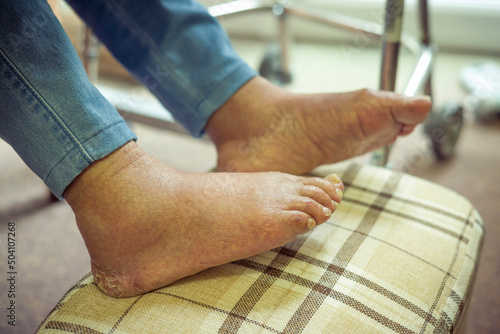 Canvas-taulu Elderly foot care, old woman with swollen feet, UK