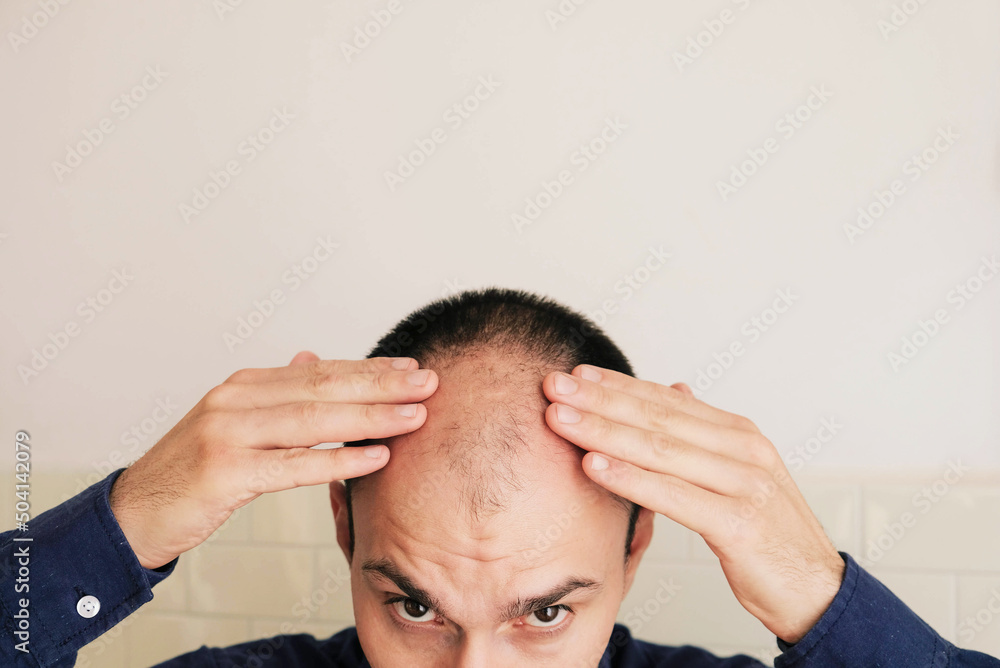 Fototapeta premium Young caucasian man looking at mirror worried about balding, close up. Baldness, alopecia in males, male pattern hair loss problem concept. Copy space for text.