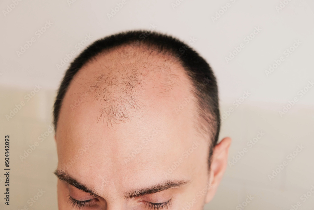 Young man losing hair on temples, close up. Baldness, alopecia in males